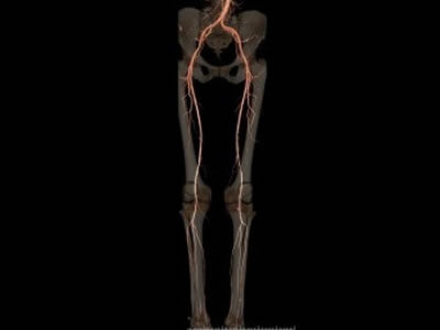 Angiotomografia de Membros Inferiores